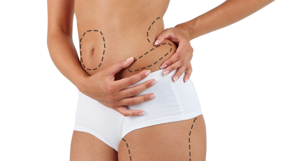 liposuction
