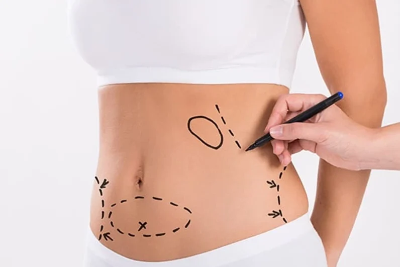 Liposuction nedir, nasıl yapılır?