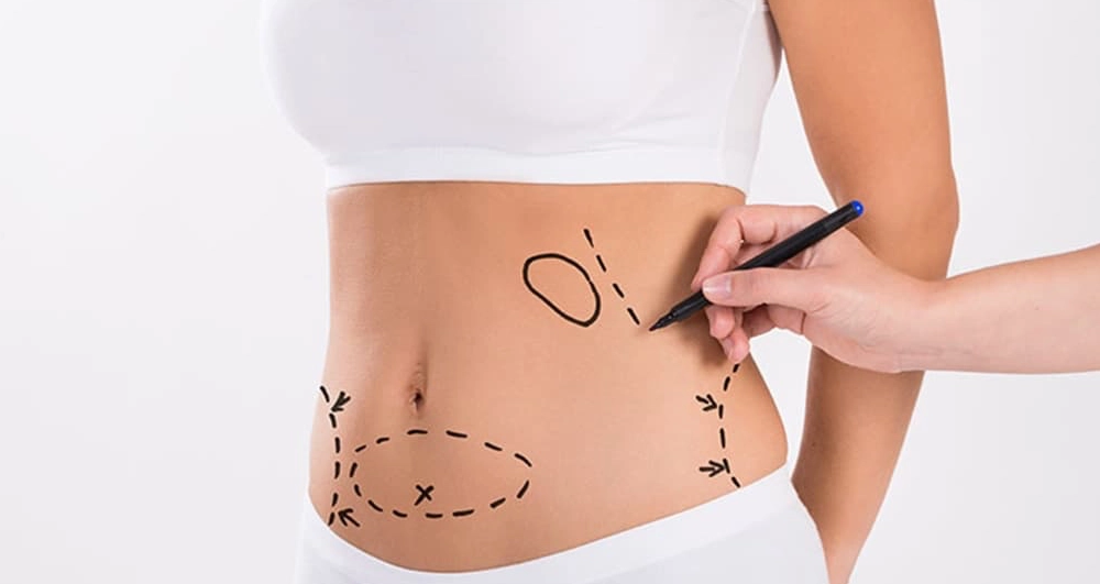 Liposuction nedir, nasıl yapılır?