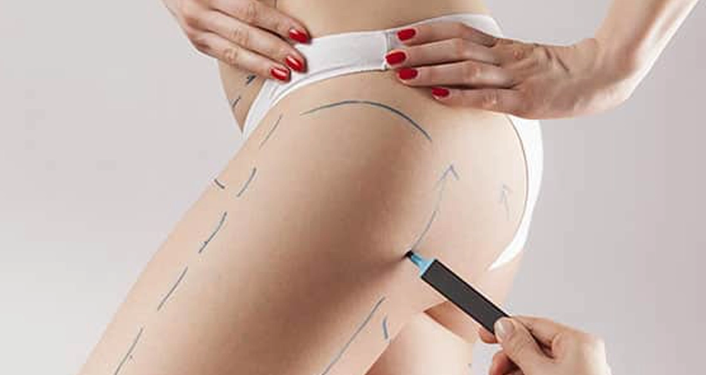 liposuction sonrası iyileşme